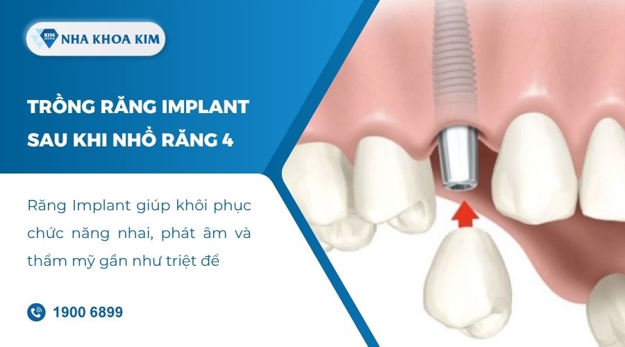 Phương pháp phục hình sau khi răng số 4