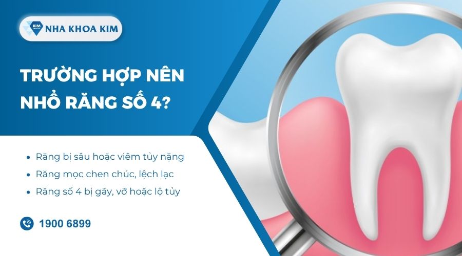 Có nên nhổ răng số 4 không?