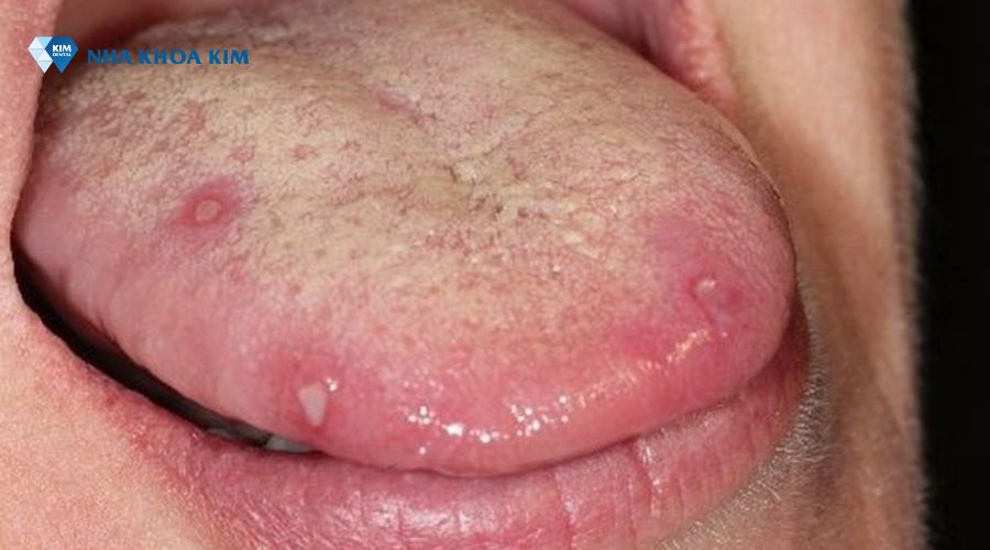 Tình trạng thường lấy ở lưỡi bị bệnh Apthae