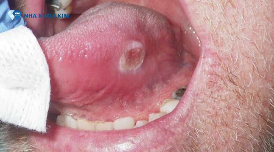 Hình ảnh người bị bệnh ung thư lưỡi