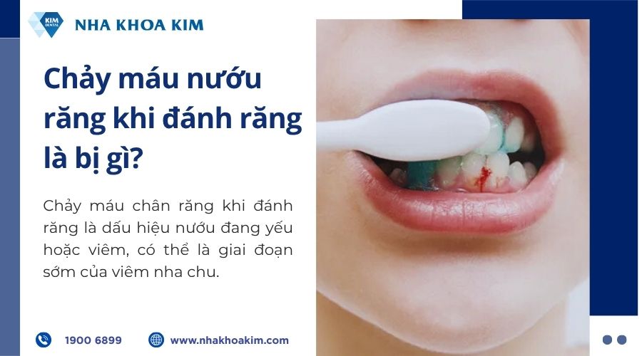 Chảy máu nướu răng khi đánh răng là bị gì?