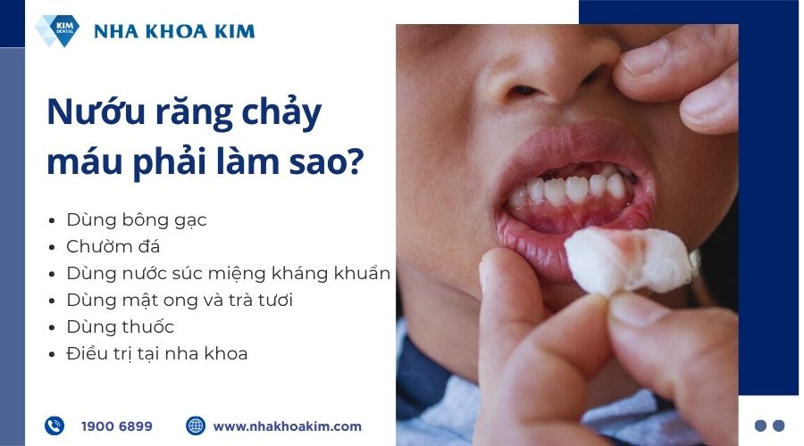 Nướu răng chảy máu phải làm sao?