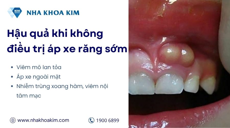 Hậu quả khi không điều trị áp xe răng sớm
