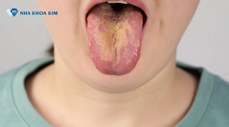 Hình ảnh lưỡi người nhiễm HIV