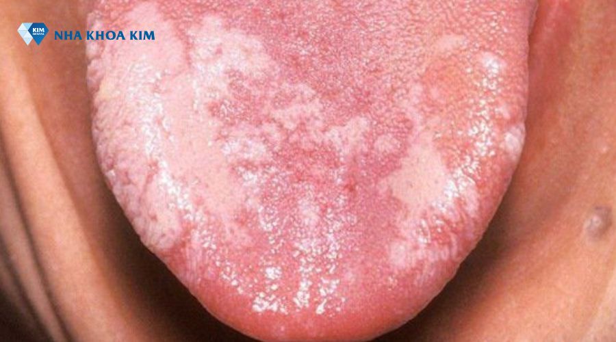 Lưỡi có đốm trắng, mảng bựa