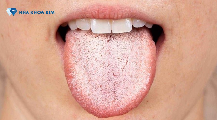 hình ảnh lưỡi bị bệnh nấm nặng nề