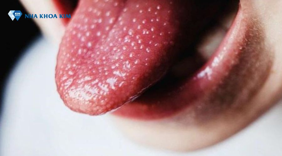 Hình ảnh lưỡi bị bệnh sốt Scarlet