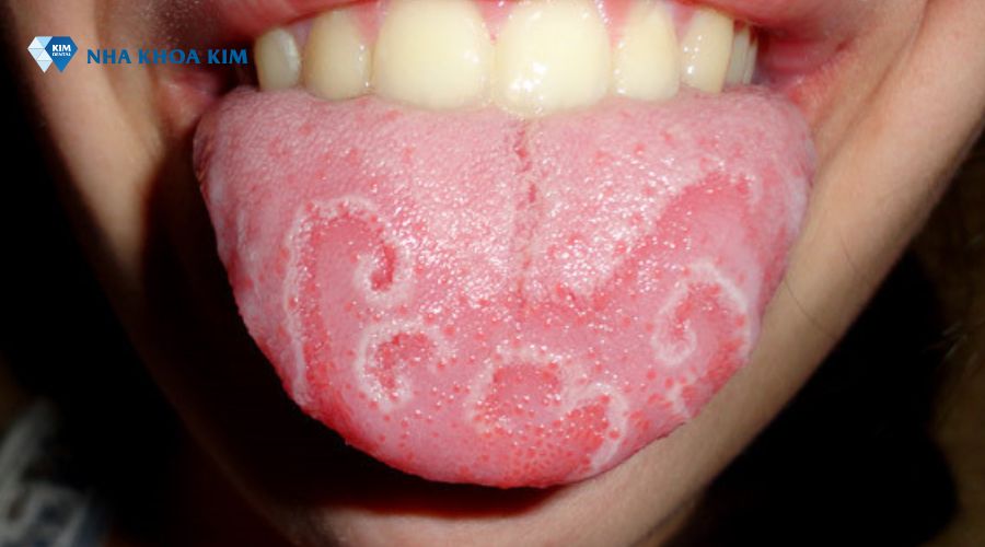 Hình ảnh lưỡi bản đồ