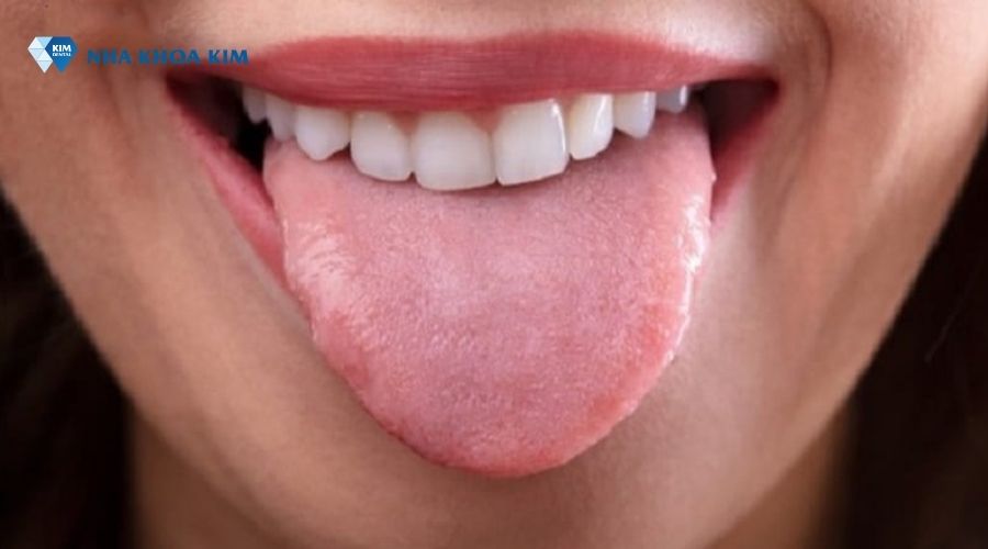 Hình ảnh lưỡi bình thường, khỏe mạnh