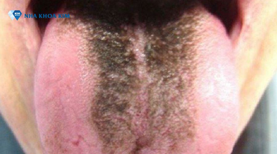 Hình ảnh lưỡi có đốm đen nhỏ