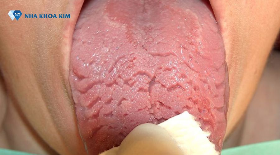 Lưỡi bị bệnh, về mặt nứt nẻ, rãnh sâu