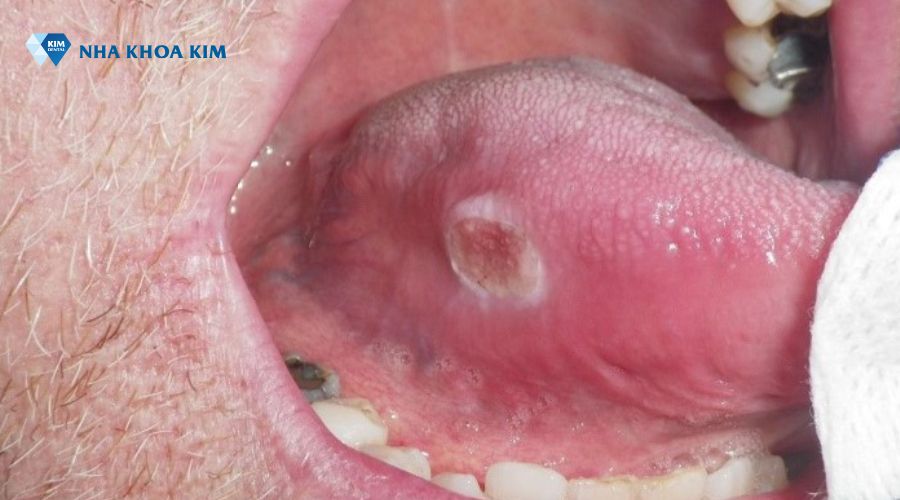 Lưỡi bị bệnh xuất hiện vết loét