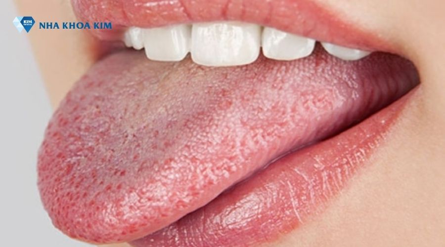 Gai lưỡi khỏe mạnh, đồng đều