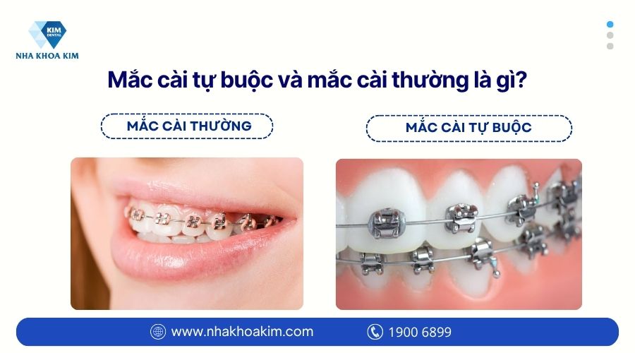 Mắc cài tự buộc và mắc cài thường là gì?