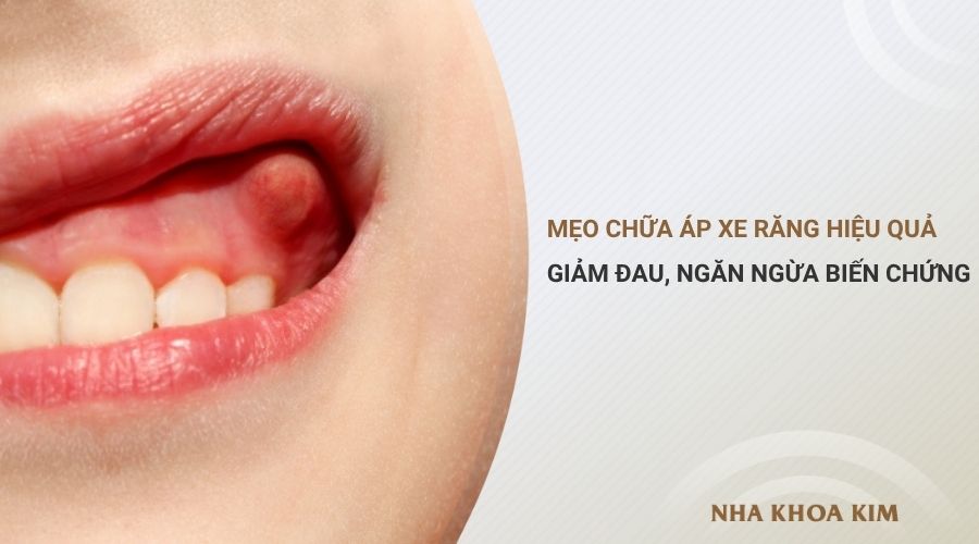 Mẹo chữa áp xe răng hiệu quả, giảm đau, ngăn ngừa biến chứng