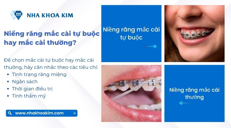Nên chọn niềng răng mắc cài tự buộc hay mắc cài thường?