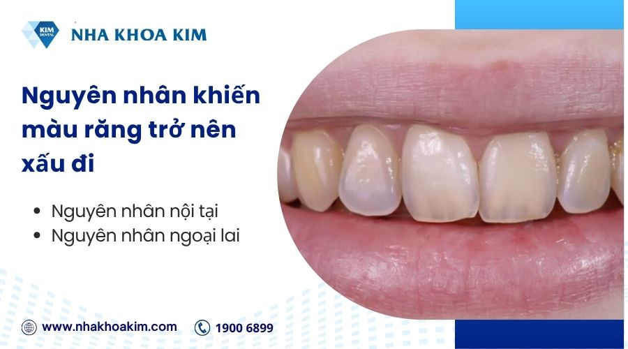 Nguyên nhân khiến răng trở nên xỉn màu