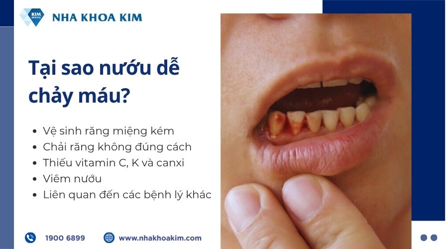 Tại sao nướu dễ chảy máu?