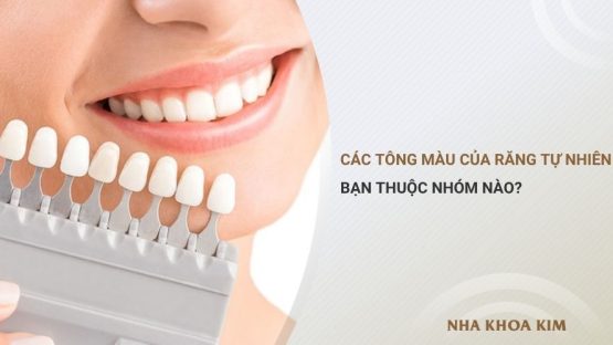 Các tông màu của răng tự nhiên: Bạn thuộc nhóm nào?
