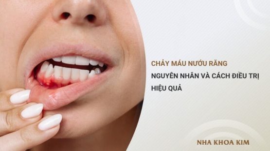 Chảy máu nướu răng: Nguyên nhân và cách điều trị hiệu quả