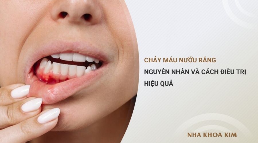 Chảy máu nướu răng: Nguyên nhân và cách điều trị hiệu quả