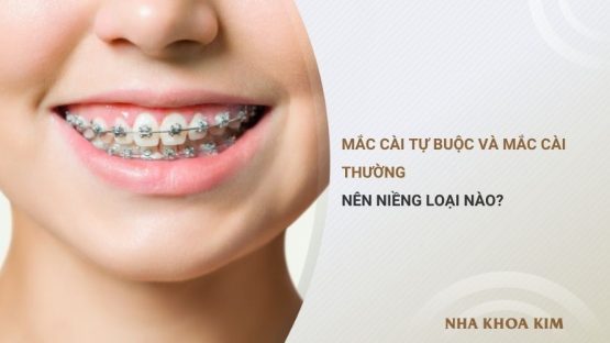 Mắc cài tự buộc và mắc cài thường: Nên niềng loại nào?