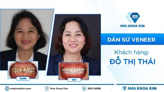 Bọc răng sứ chuẩn vàng – Nụ cười tự nhiên, Hoàn hảo tại Nha Khoa Kim