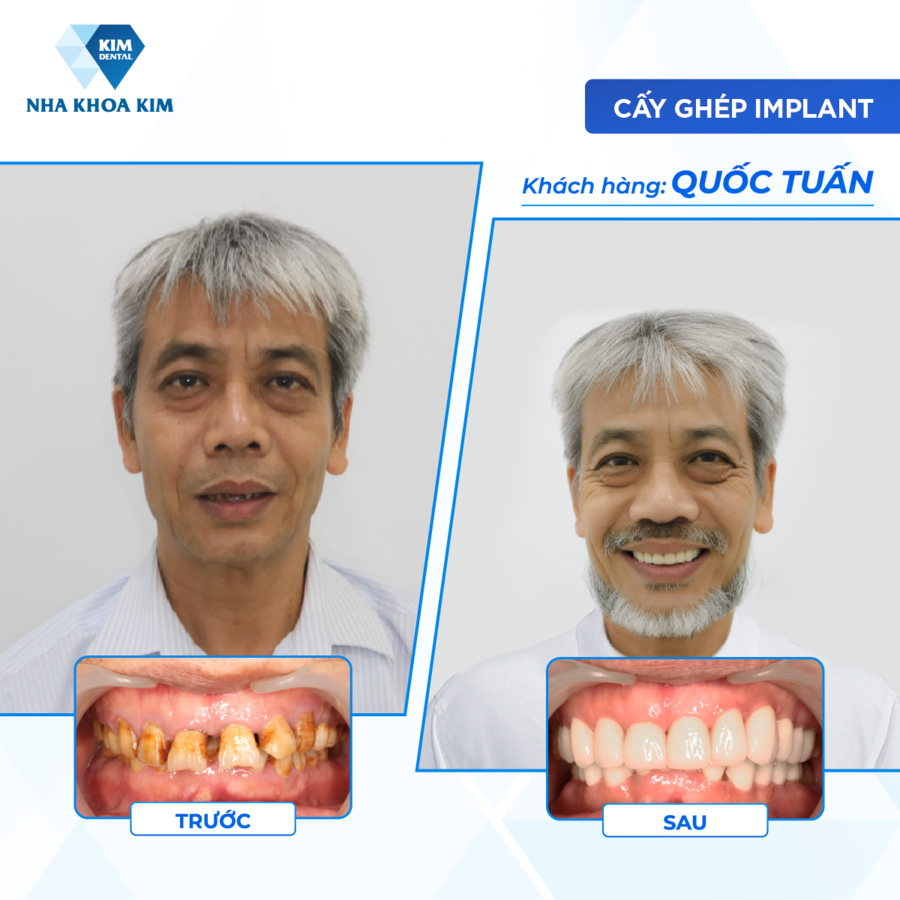 Cấy ghép Implant không chỉ giúp phục hồi răng đã mất, mà còn bảo tồn cấu trúc xương hàm và trẻ hóa khuôn mặt.
