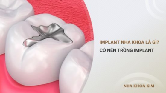 Implant nha khoa​ là gì? Có nên trồng implant nha khoa không?