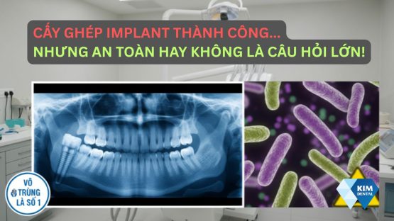 Cấy ghép implant thành công, nhưng an toàn hay không là câu hỏi lớn