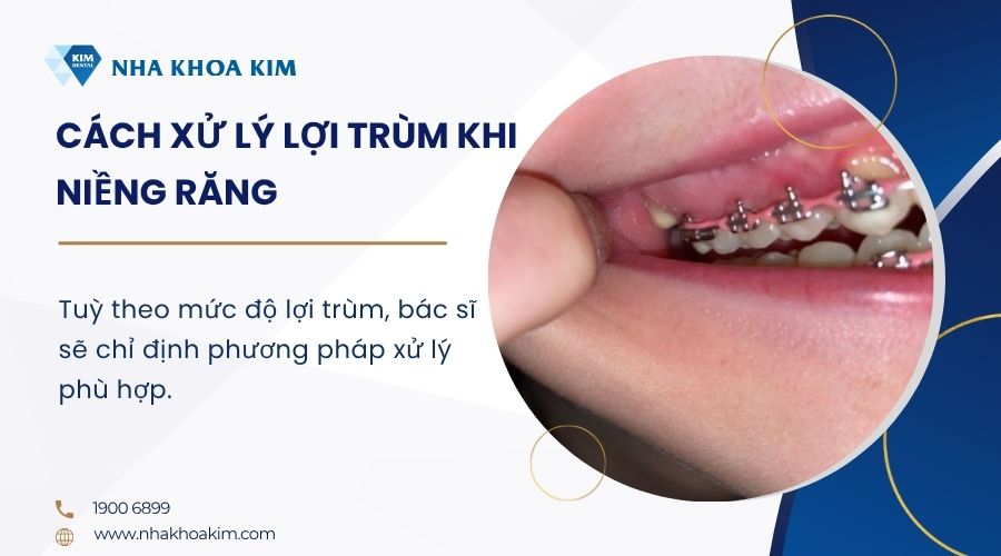 Cách xử lý lợi trùm khi niềng răng