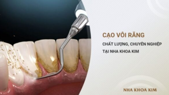 Cạo Vôi Răng An Toàn – Chuẩn Y Khoa