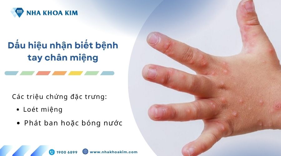 Dấu hiệu nhận biết bệnh tay chân miệng