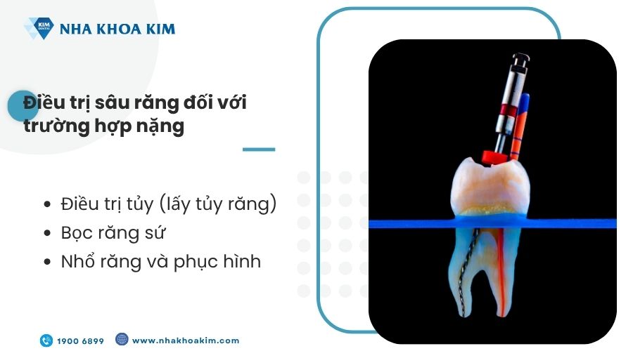 Điều trị sâu răng đối với trường hợp sâu răng nặng
