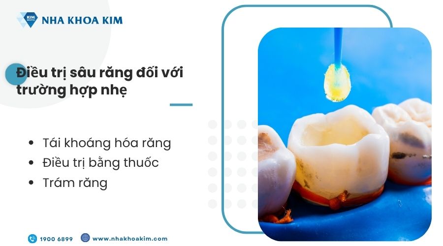 Điều trị sâu răng đối với trường hợp nhẹ