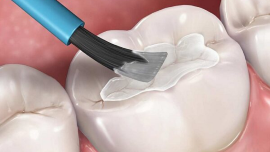 Giá hàn trám răng giá bao nhiêu tiền tại Nha Khoa Kim?