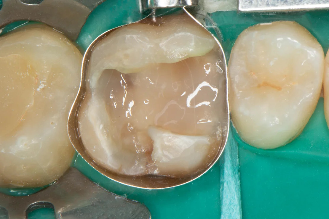 Hàn trám răng là gì?