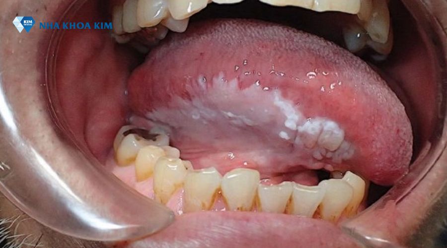 Bệnh bạch sản xuất hiện mảng trắng dưới lưỡi