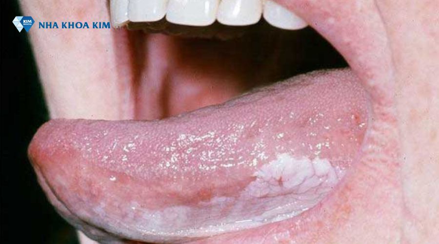 Mảng trắng đặc trưng của bệnh Leukoplakia trong khoang miệng