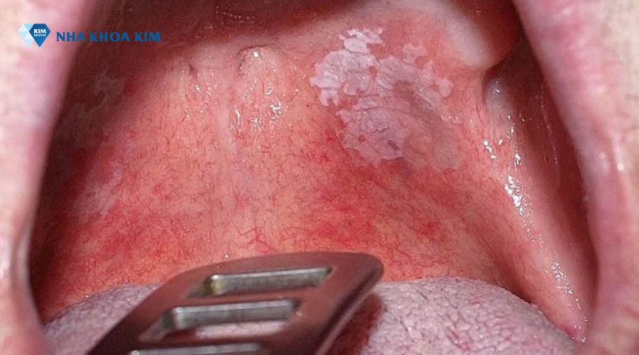Bệnh bạch sản trong khoang miệng