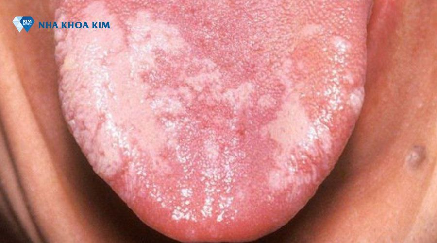 Hình ảnh bệnh bạch sản lưỡi