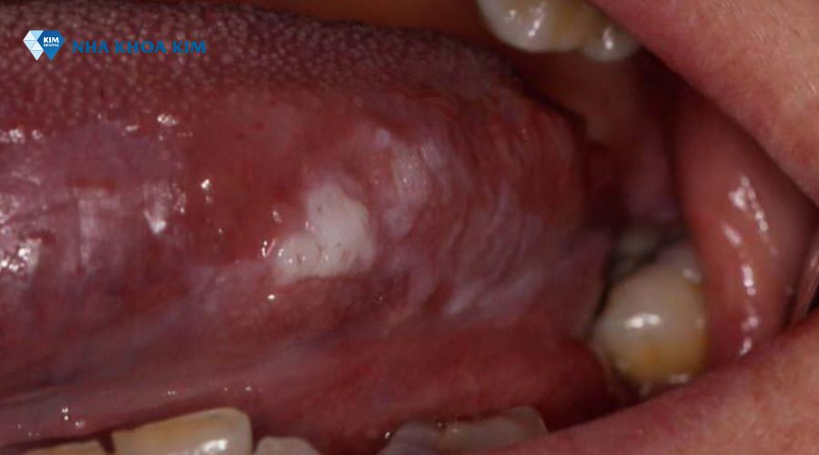 Bệnh bạch sản lưỡi 