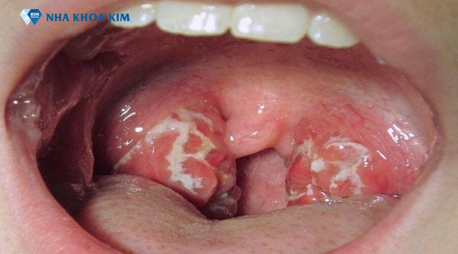 Viêm họng mãn tính có mủ trắng