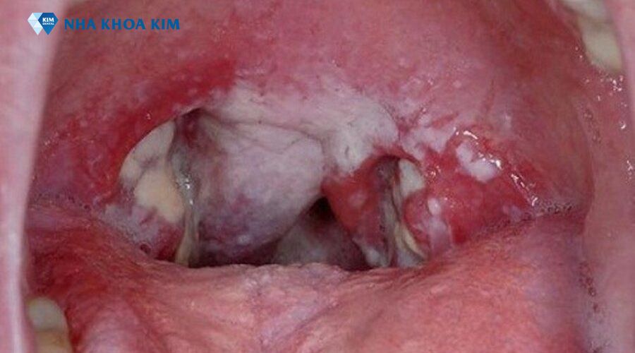 viêm họng hạt do vi khuẩn với niêm mạc họng đỏ rực, các hạt lympho lớn