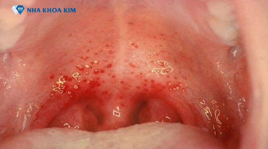 Viêm họng hạt do virus