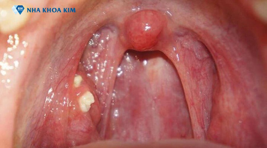 Viêm họng hạt mãn tính