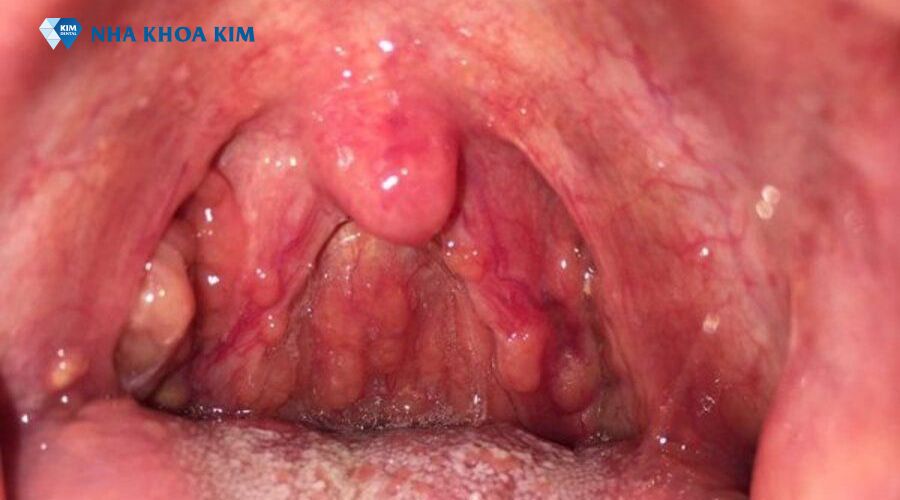 họng hạt mãn tính với các hạt lympho