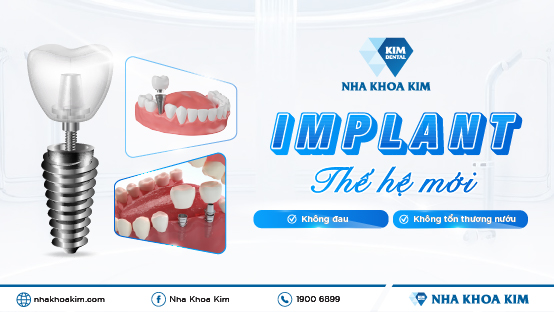 Cấy Ghép Implant Thế Hệ Mới – Giải Pháp Chuẩn Y Khoa Tại Nha Khoa Kim
