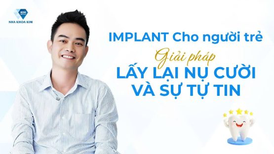 Implant cho người Trẻ Trung Niên – Giải pháp lấy lại Nụ Cười và Sự Tự Tin