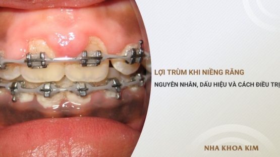 Lợi trùm khi niềng răng: Nguyên nhân, dấu hiệu và cách xử lý